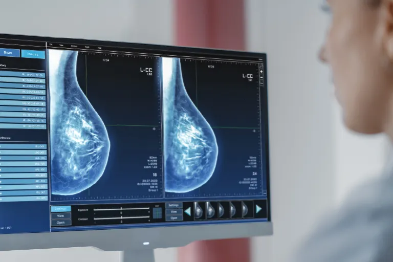 AI model targets aggressive breast cancer
